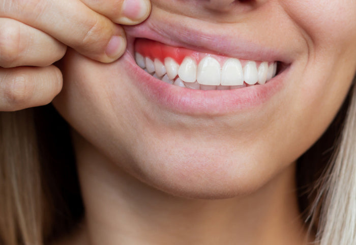 Riešenie krvácajúcich ďasien.